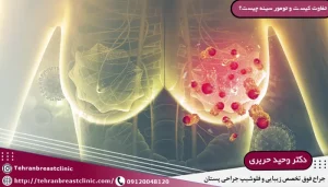 تفاوت کیست و تومور سینه، علت به وجود آمدن كيست سينه
