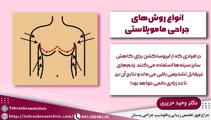انواع روشهای جراحی ماموپلاستی