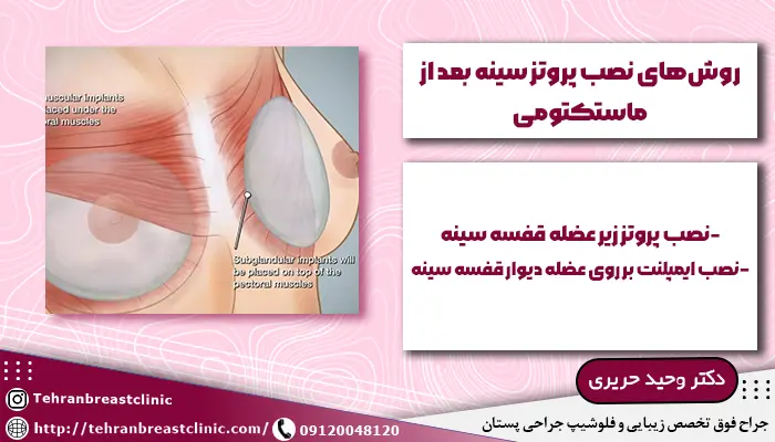 روش نصب پروتز سینه بعد از ماستکتومی