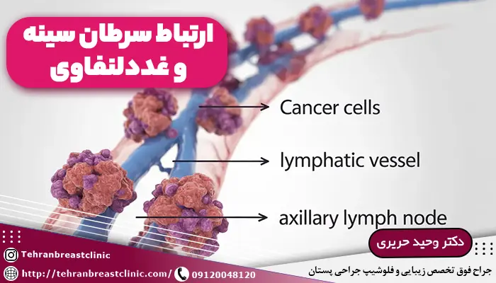 ارتباط سرطان سينه و غددلنفاوی