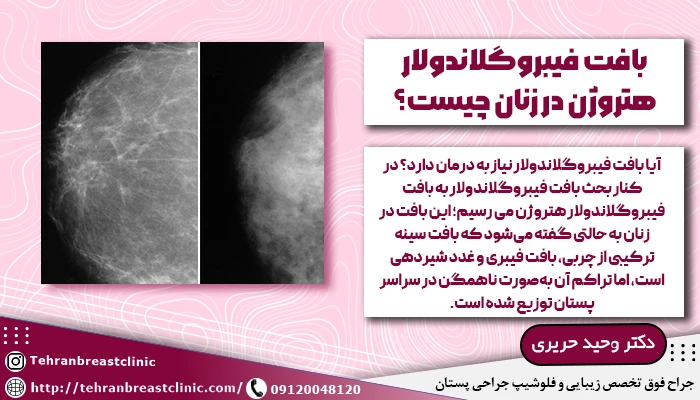بافت فیبروگلاندولار هتروژن در زنان چیست؟