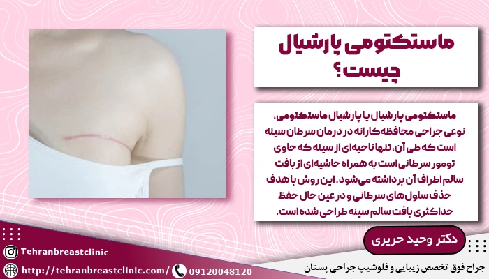 ماستکتومی پارشیال چیست؟