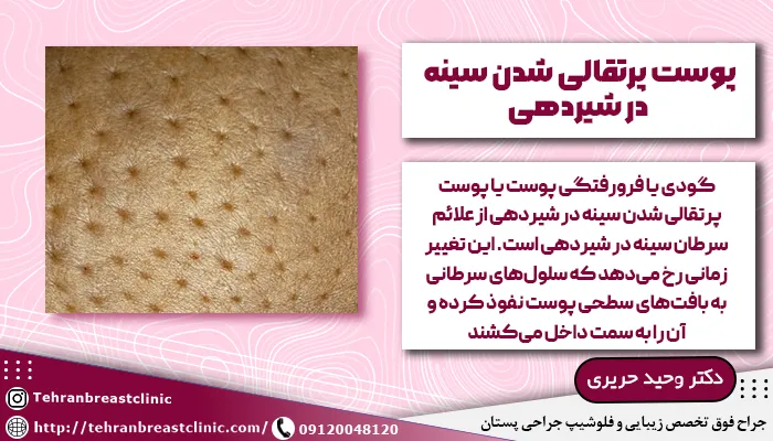 پوست پرتقالی شدن سينه در شیردهی