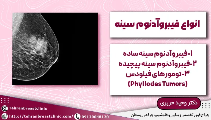 انواع فیبروآدنوم سینه
