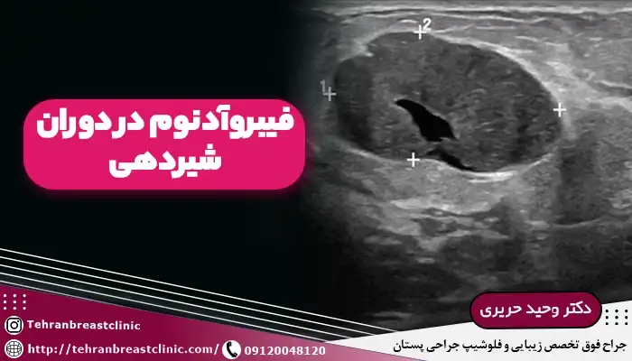 فیبروآدنوم در دوران شیردهی