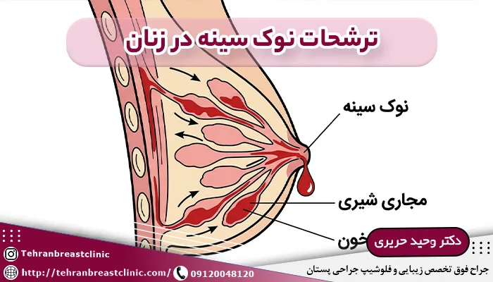 ترشحات نوک سینه در زنان