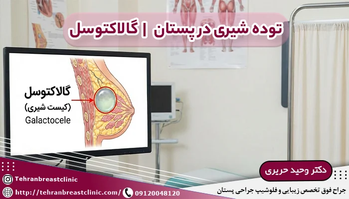 توده شیری در پستان یا گالاکتوسل