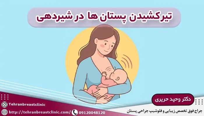 تیر کشیدن پستان ها در شیردهی