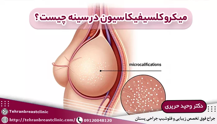 میکروکلسیفیکاسیون در سینه چیست؟