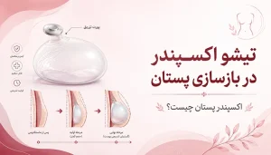 تیشو اکسپندر در بازسازی پستان | اکسپندر پستان چیست؟