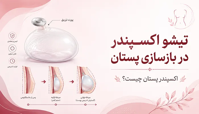 تیشو اکسپندر در بازسازی پستان | اکسپندر پستان چیست؟