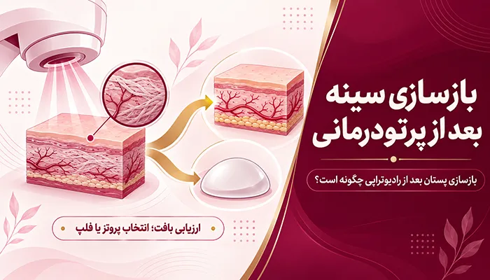 بازسازی سینه بعد از پرتودرمانی؛ بازسازی پستان بعد از رادیوتراپی چگونه است؟